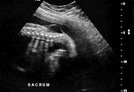 <p><span><span>A sagittal image of the lower spine is most suspicious for:<br></span></span></p>