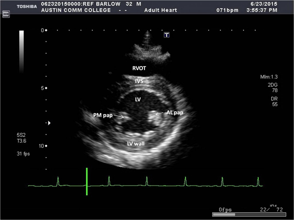 * LV
* RV
* IVS
* Anterolateral and posterolateral papillary muscles
* Inferior LV wall