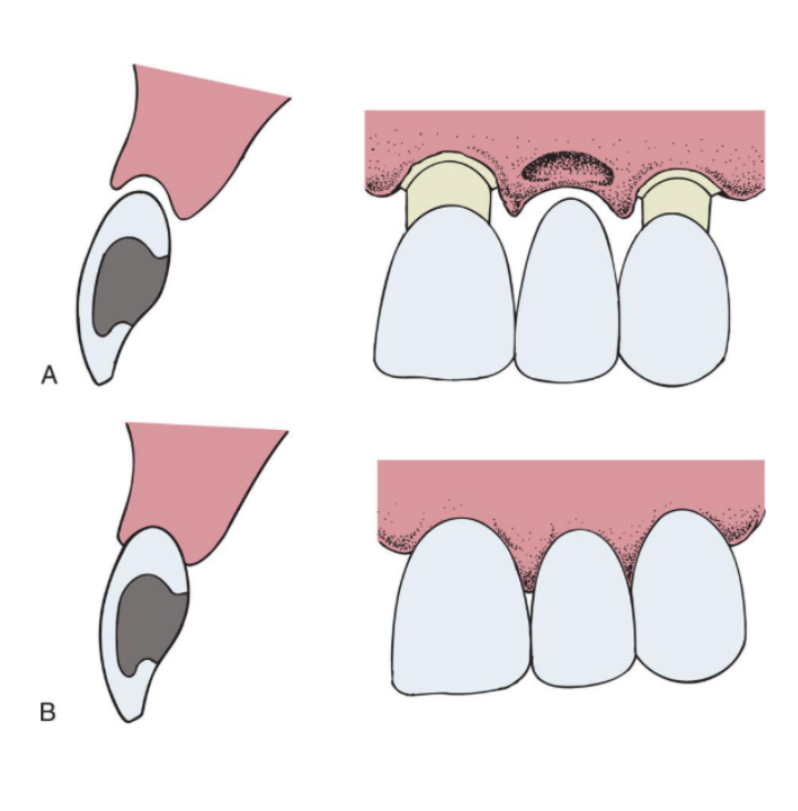 <ul><li><p>most esthetic</p></li><li><p>stronger than modified ridge-lap pontic</p></li><li><p>not susceptible to food impaction</p></li><li><p>easy to clean</p></li></ul><p></p>