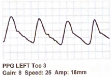 <p>Describe this digital PPG waveform:</p>