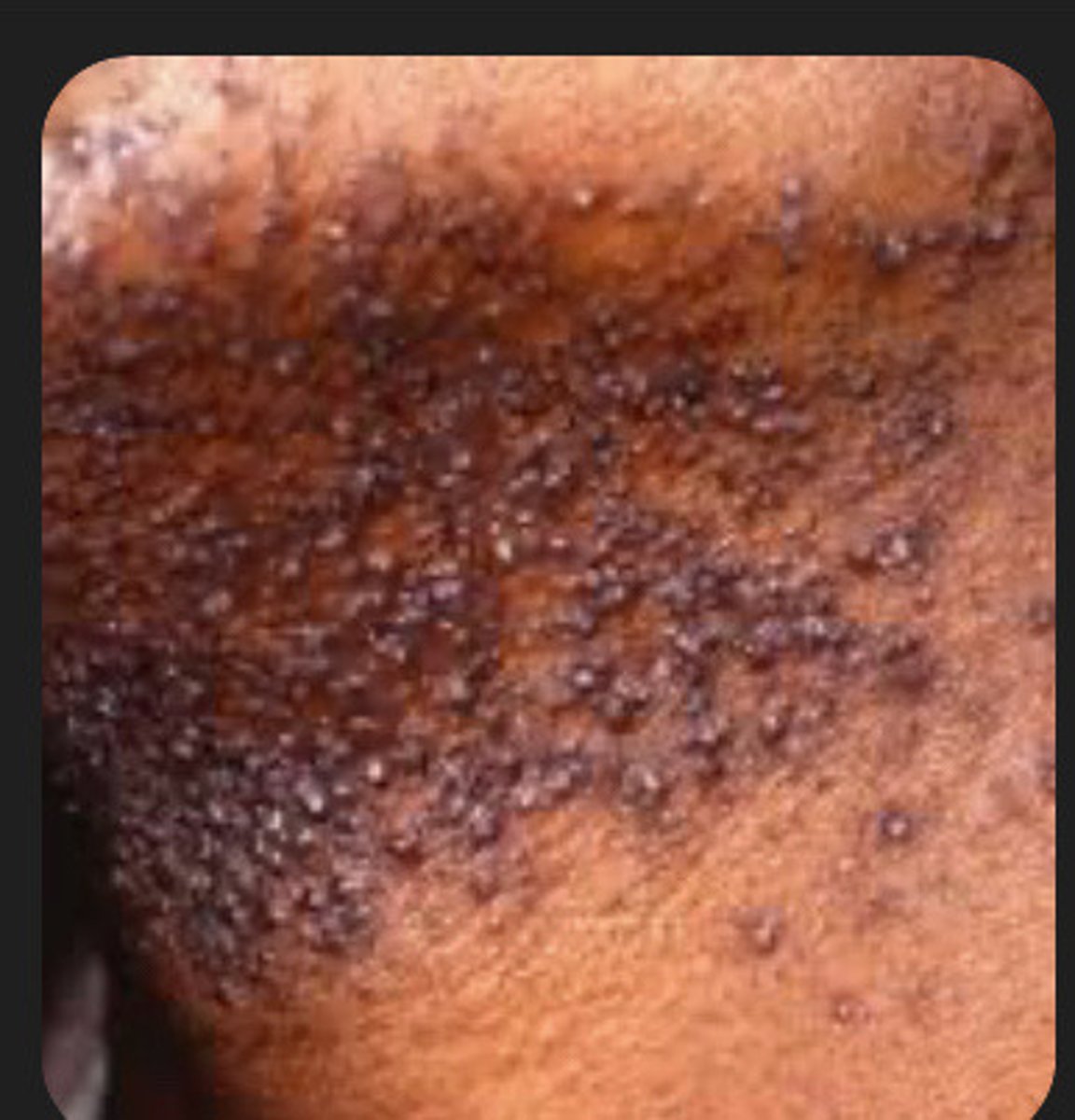 <p>Pseudo Folliculitis Barbe</p>