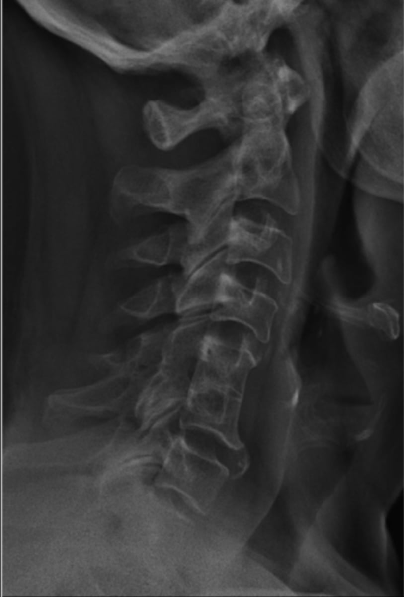<p>Block vertebrae appearance</p>
