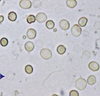 <ul><li><p>in dilute urine</p></li><li><p>Not included in microscopic count</p></li></ul><p></p>