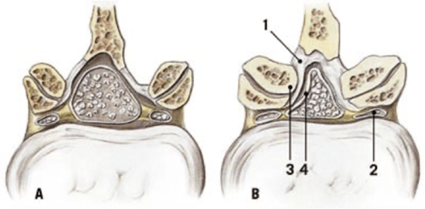 <p>ID complication of degenerative lumbar spine disease</p>