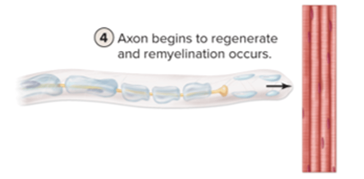 <p>axon begins to regenerate and remyelination occurs</p>