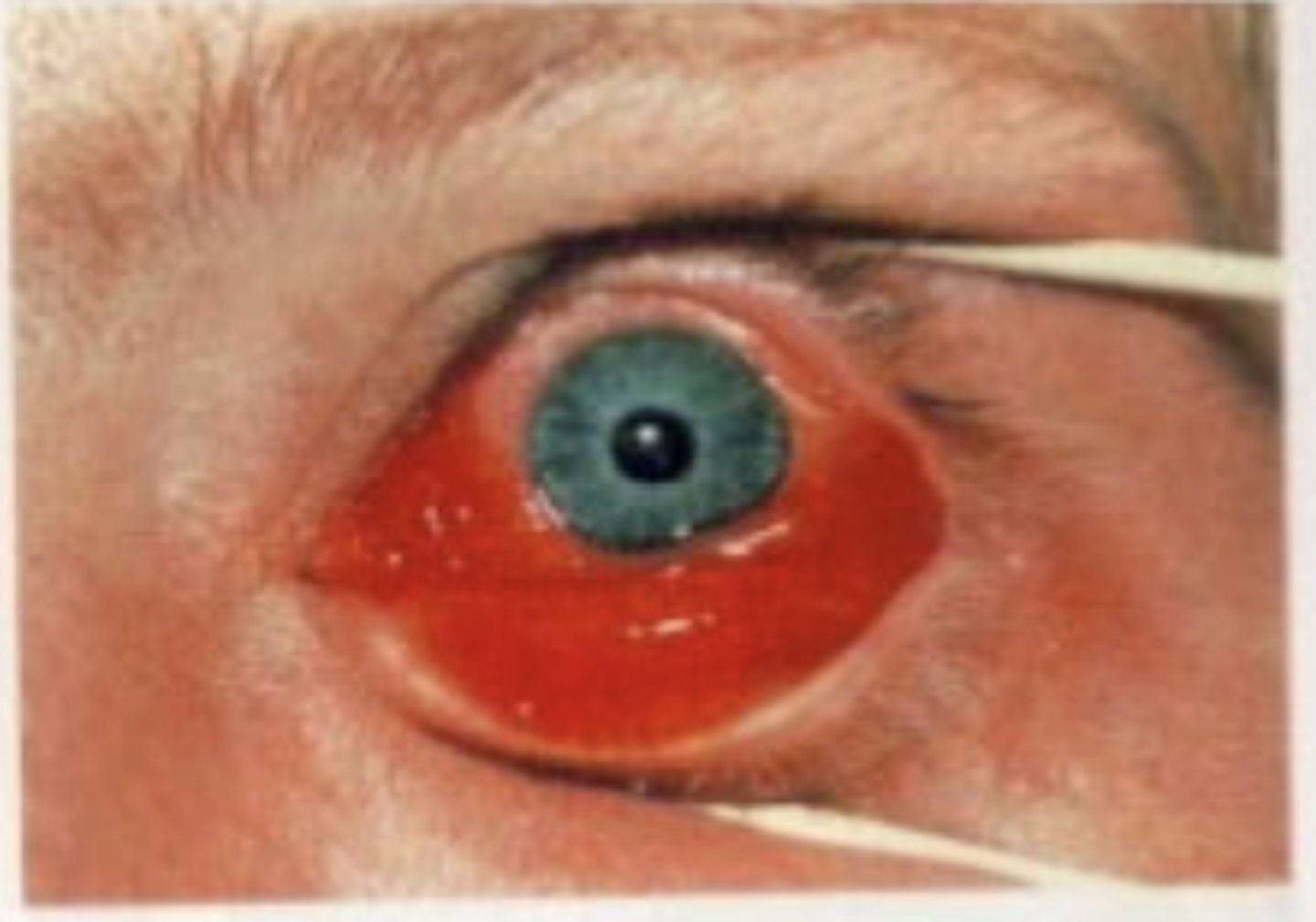 <p>Type of adenovirus</p><p>- 3 and 7</p><p>Symptoms</p><p>Accompanied by pharynconjunctival fever</p>