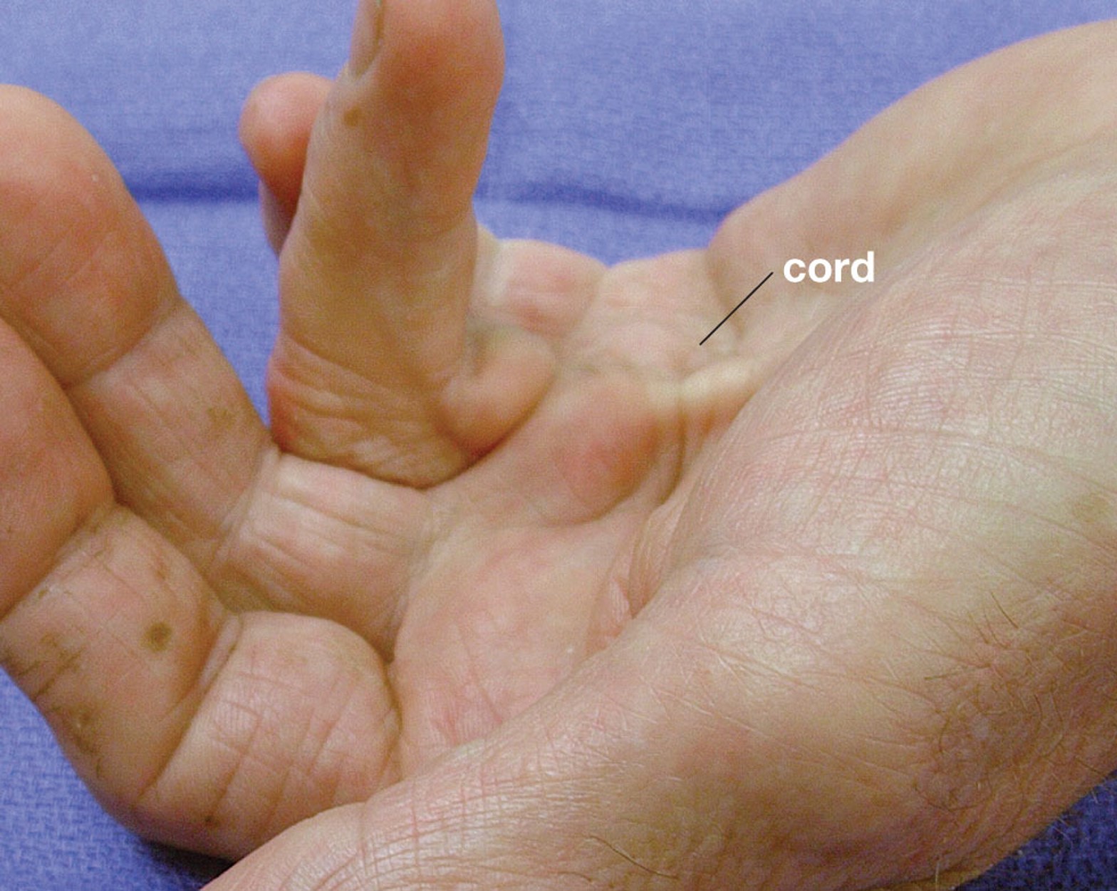 what type of scar formation is this?
