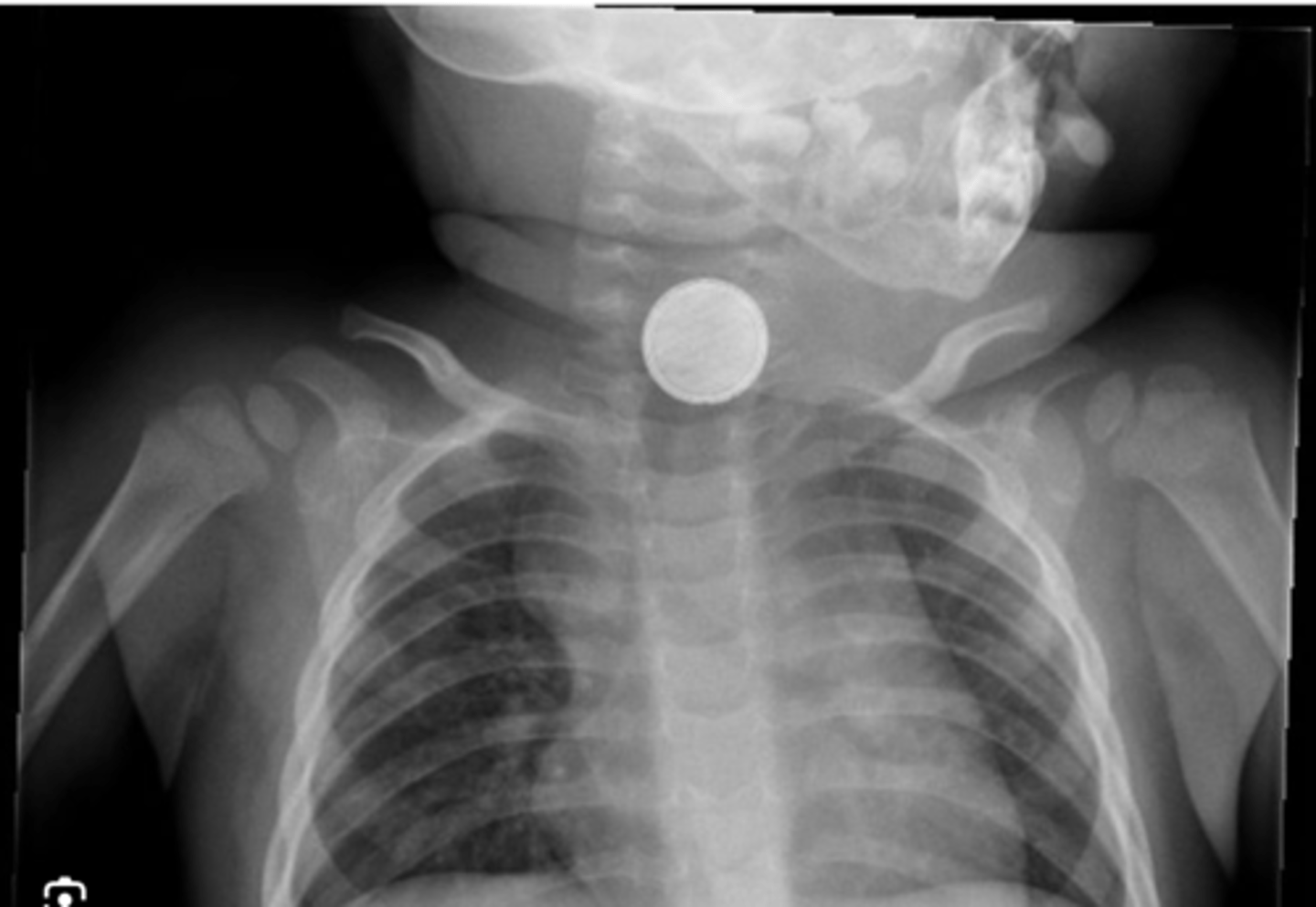 <p>- when ingested, button batteries react with water & cause alkaline caustic injury i.e. tissue liquefaction within 2 hours.</p><p>- it could lead to damage to oesophageal tissue, intestinal tissue, arterial etc. Could even lead to death.</p>