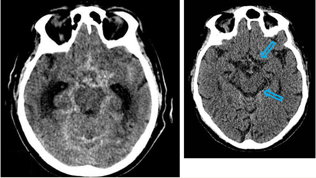 <p>Patient history: “worst headache” in life with acute onset and nausea in a 42-year-old patient </p><p>Modality: non-enhanced CT </p><p>Region: brain, axial view </p><p>Radiologic sign: cast-like hyperdensity filling the basal cisterns and sulci (normal hypodens, liquor-filled cysterns are shown on the right image, blue arrow) </p><p>Diagnosis: acute subarachnoid hemorrhage, most commonly due to berry aneurysm rupture</p>