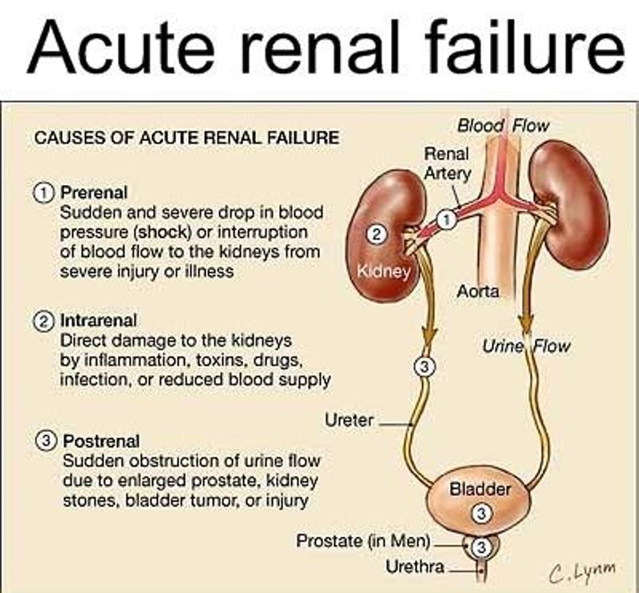 <p>Intrinsic, prerenal, and postrenal.</p>