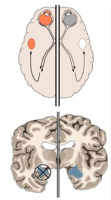 -ablation unilatérale de l'amygdale (une seule) chez le singe 
-section aussi du chiasma optique et de l'ensemble des commissures (point de jonction de deux ou plusieurs parties d'un organe) qui unissent les 2 hémisphères cérébraux
-on obtient donc un singe avec une seule amygdale qui n'a accès qu'aux infos visuelles émanant de l'œil ipsilatéral 