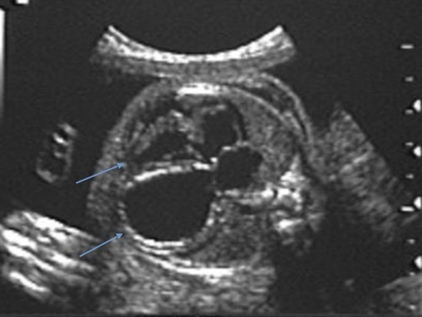 <p>Enlarged heart</p>