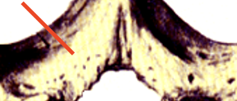 <p>connect the transverse processes with the spinous process </p>