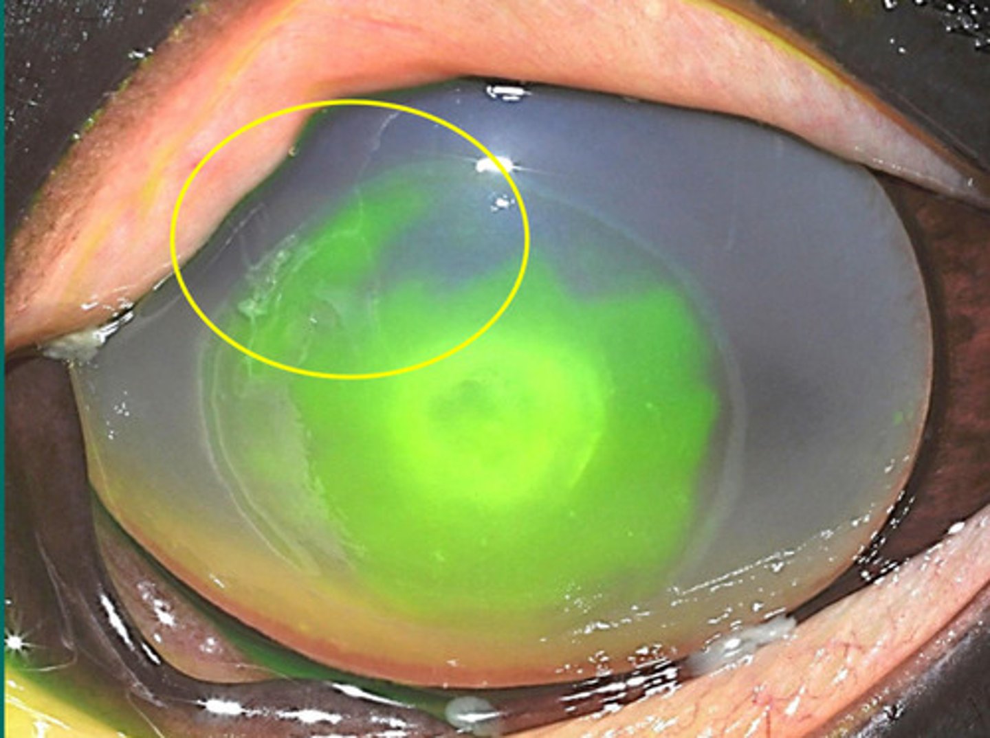 <p>What does this appearance tell you about ulcer healing?</p>