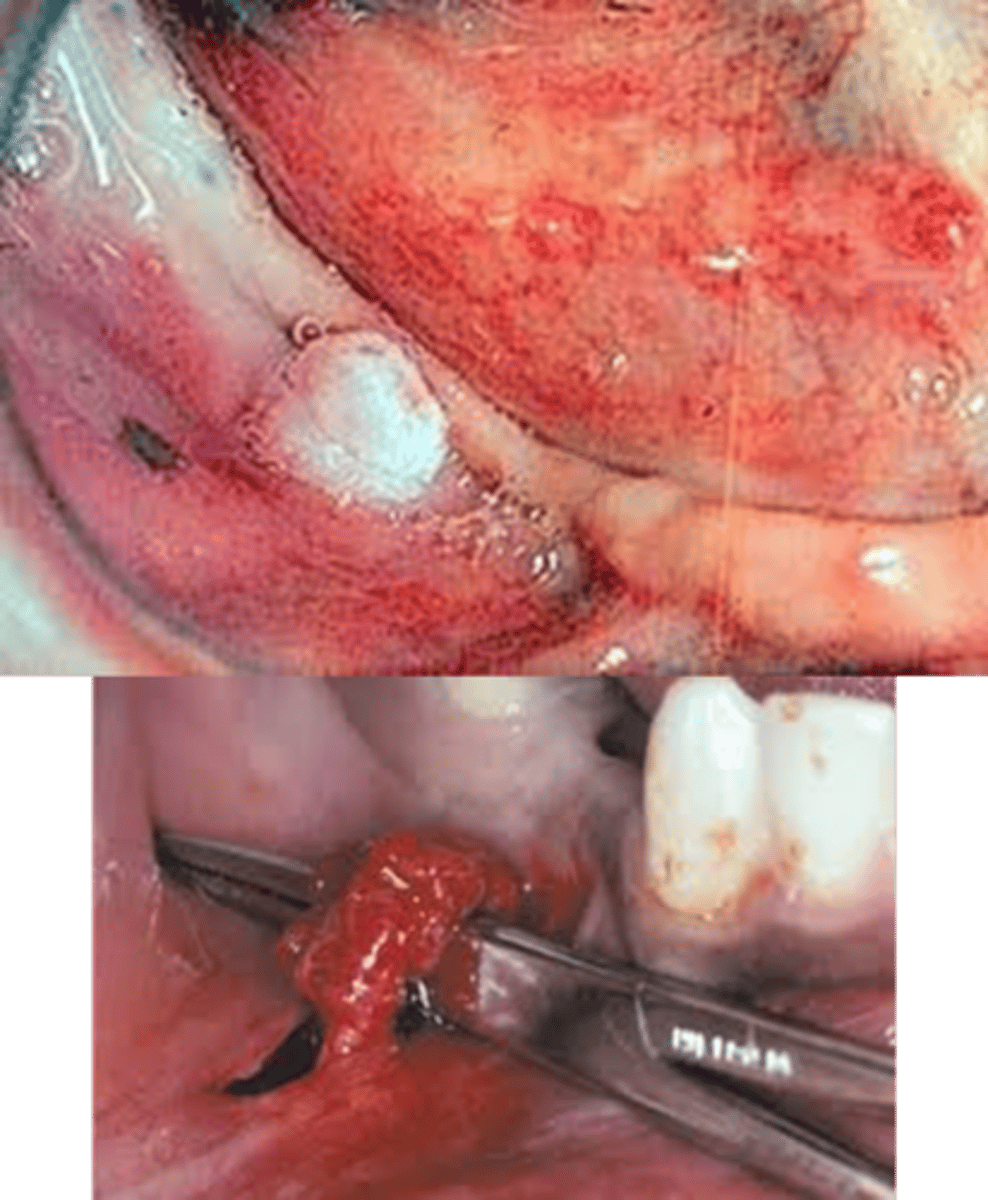 <p>• Smooth-surfaced, nonulcerated</p><p>nodules</p><p>• Most common in the mental</p><p>foramen area, tongue, and lower</p><p>lip</p><p>• A history of trauma often can be</p><p>elicited</p><p>• May be intraosseous</p><p>• About 1/3 are painful</p>