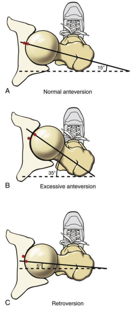 <p>torsion of the femur: </p><ul><li><p>twist between shaft and neck in the transverse plane</p></li><li><p>neck projects anterior to a M/L axis through the femoral condyles </p></li><li><p>birth 30=40 degrees</p></li><li><p>by skeletal maturity, normal angle: 15-18 degrees </p></li></ul><p></p>