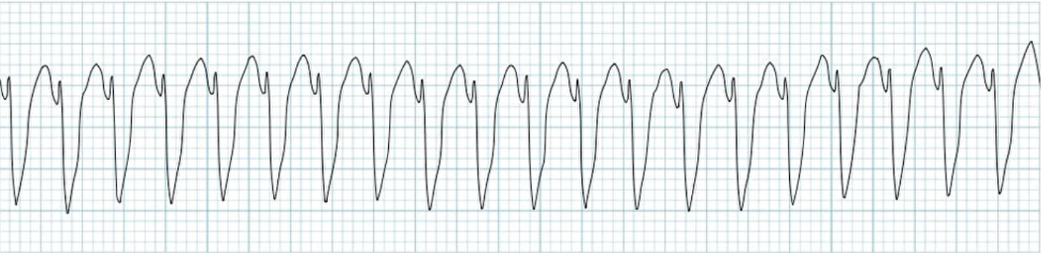 <p>What does this EKG represent?</p>