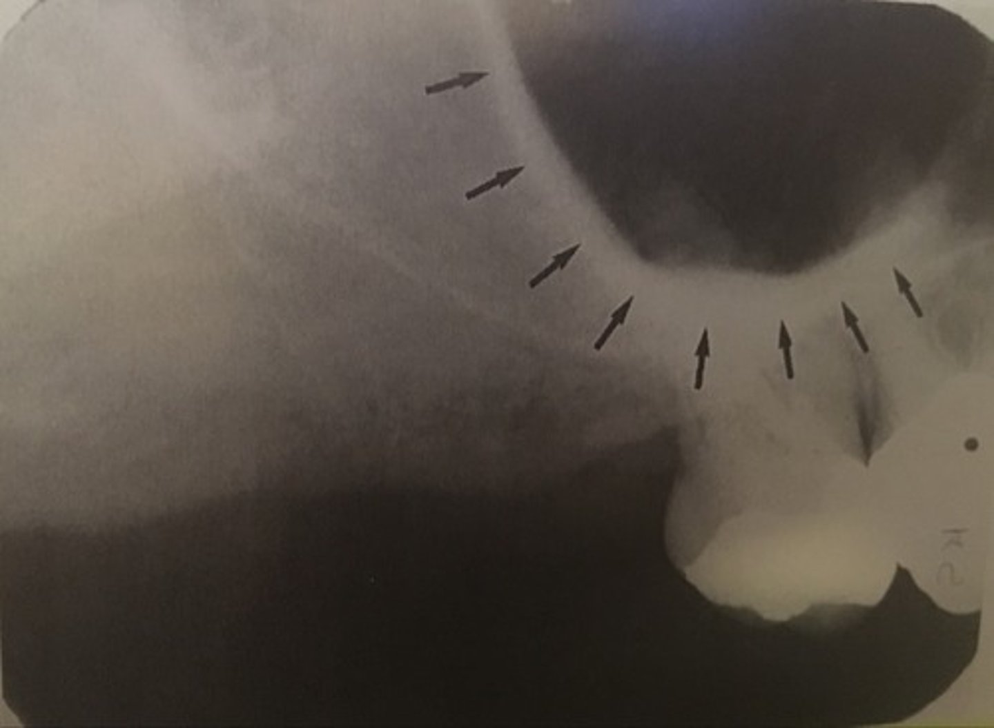 <p>J or U shaped</p><p>maxillary 1st molar region</p><p>radiopaque</p>