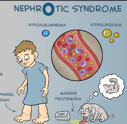 <p><strong>A 9-year-old boy has been diagnosed with the nephrotic syndrome. Place the following stages in the development of his health problem in ascending order. Use all the options.</strong></p><p>A) Hypoalbuminemia</p><p>B) Increased glomerular membrane permeability</p><p>C) Decreased colloidal osmotic pressure</p><p>D) Proteins escape from the plasma to the glomerular filtrate</p><p>E) Accumulation of fluid in the interstitial tissue (edema) </p>