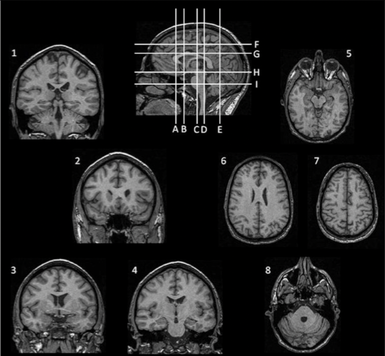 
For the next two questions, match the images numbered 1-8 with the lines labeled A-I, which indicate possible locations of the sections through the head.

Identify the INCORRECT matching of image to section level.

A. image 6 = level G
B. image 3 = level B
C. image 1 = level D
D. image 8 = level E
E. image 5 = level H