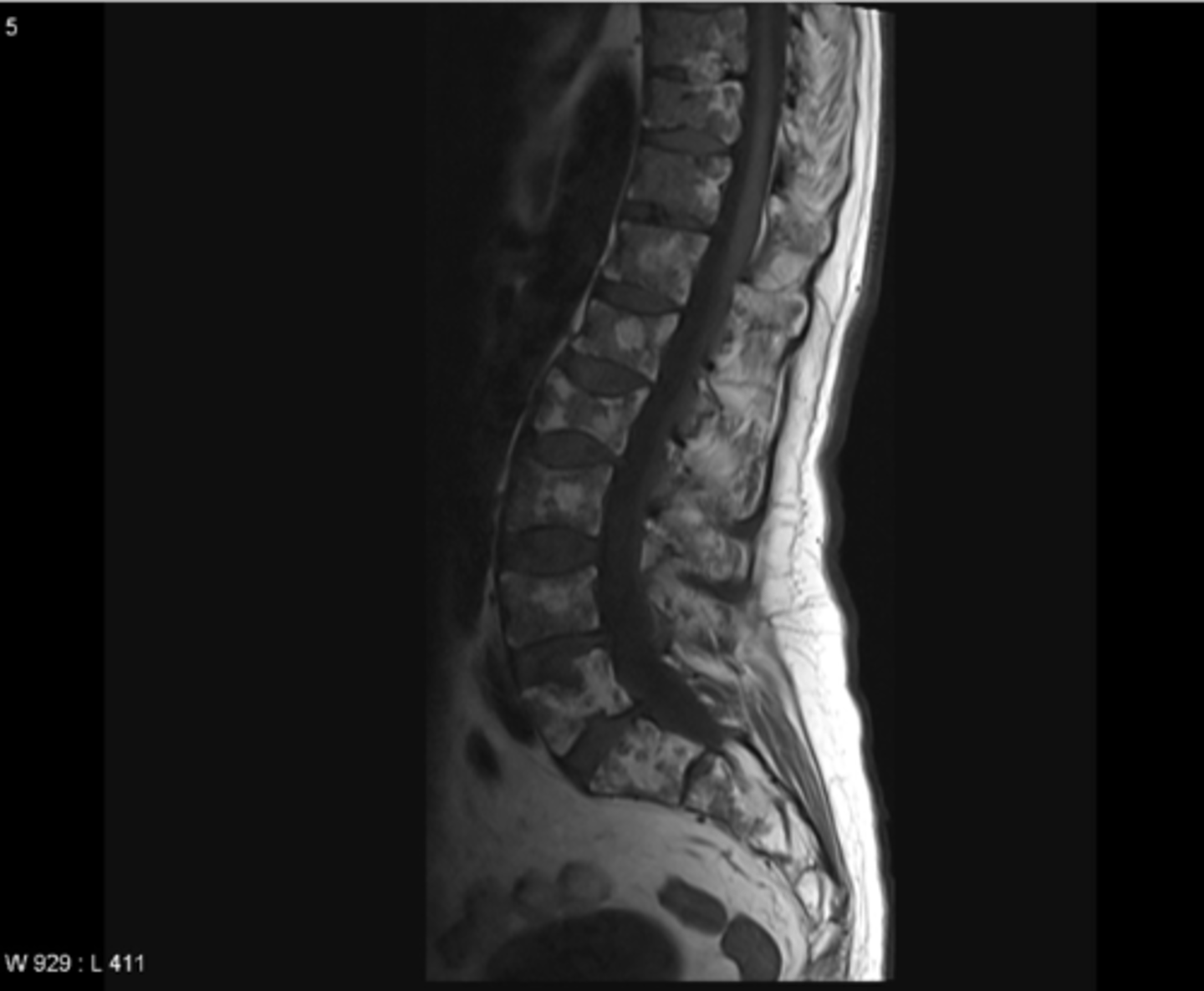 <p>multiple myeloma</p>