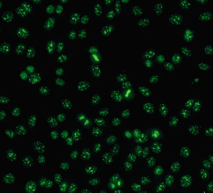 <p><span><u>Anticentromere </u>antibody reacts with centromeric chromatin</span><br><br><span>Highly selected for CREST variant of PSS </span><br><span>Found infrequently in SLE, MCTD, PSS</span><br><span>- CREST: v<u>ariant of systemic sclerosis&nbsp;haracterized by Calcinosis, Raynaud phenomenon, Esophageal motility abnormalities, Sclerodactyly, and Telangectasis</u></span></p><p></p>