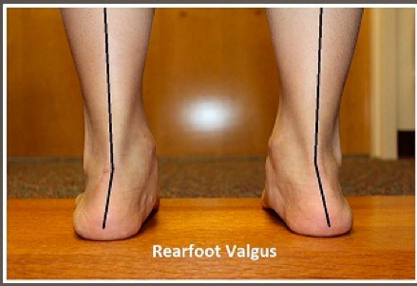 <p>MCL at risk of damage, deviates laterally</p>