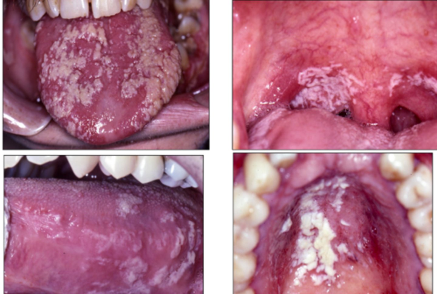 <p>candidiasis</p><p>- resistant to treatment</p>