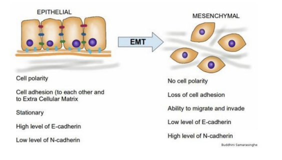 <p>epithelia cells acquire mesenchymal traits</p><ul><li><p>loss of adherent junctions, change in cellular morphology, increased motility</p></li><li><p>roughly 90% of cancers arise as carcinomas in epithelial (surface) tissue</p></li></ul>