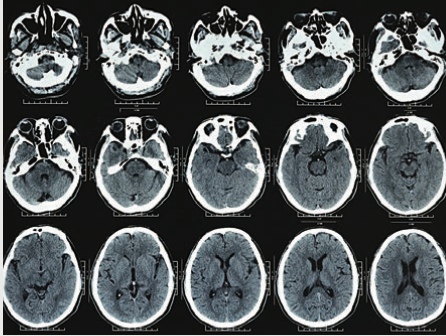 involves taking continuous two-dimensional x-ray images of the brain which are then stacked to create a comprehensive three-dimensional image of the brain.