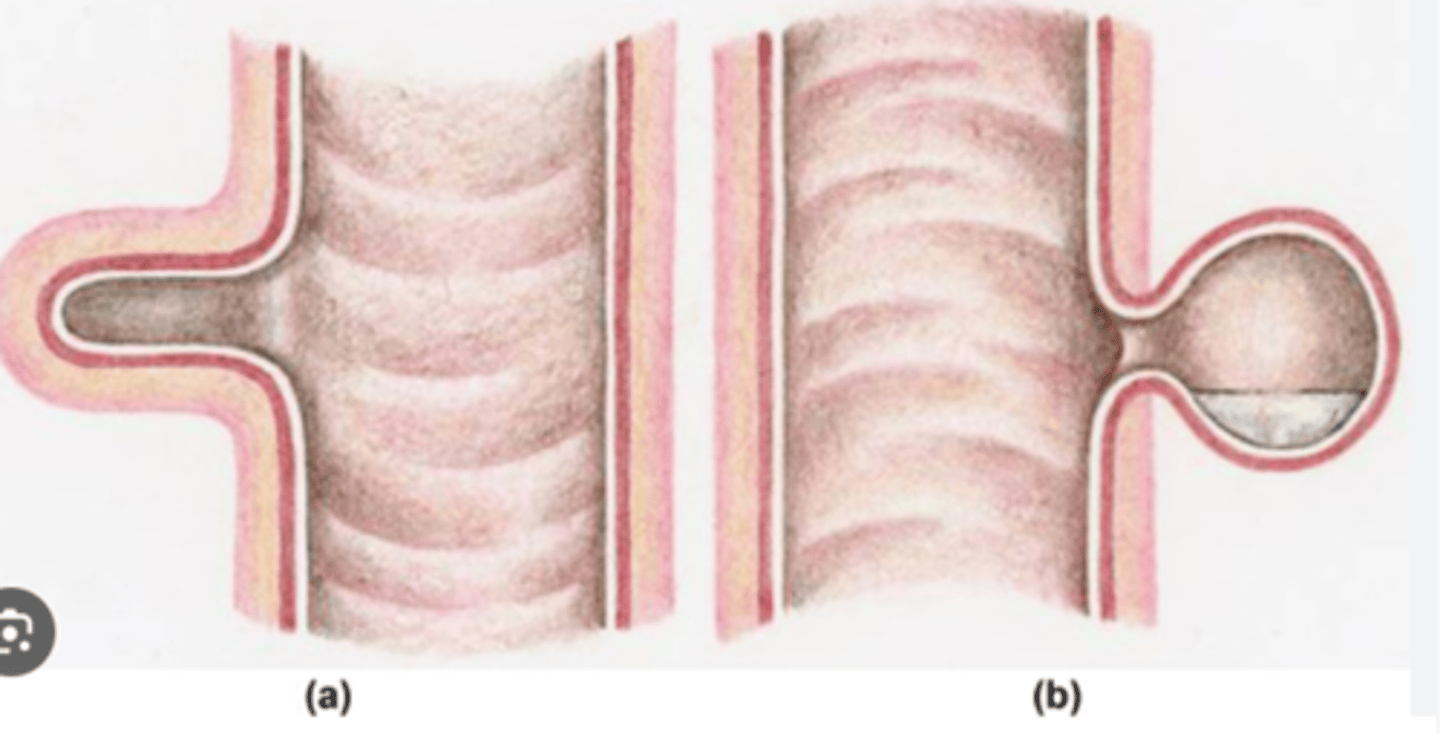 <p>What are the two types of diverticula?</p>