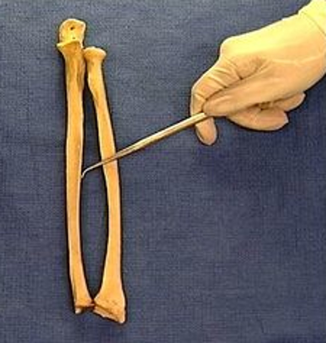 <p>a distinct, rough, irregular border of the ulna where an expansive but low eminence is found. This eminence is the place of articulation with the radius by a heavy ligament</p>