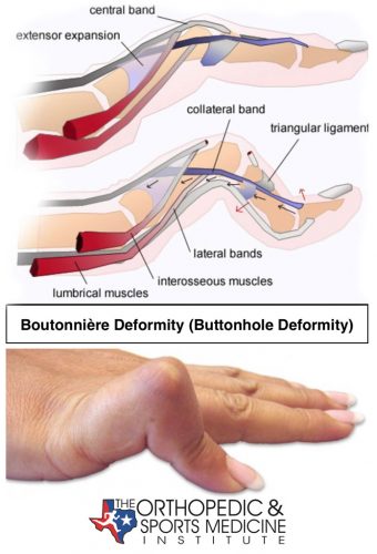 <ul><li><p><strong><mark data-color="blue" style="background-color: blue; color: inherit">boutonniere deformity</mark></strong></p></li><li><p><strong><mark data-color="purple" style="background-color: purple; color: inherit">0-6wks:</mark></strong> PIP extension orthosis (DIP free)</p><ul><li><p>AROM of DIP</p></li></ul></li></ul><p></p>