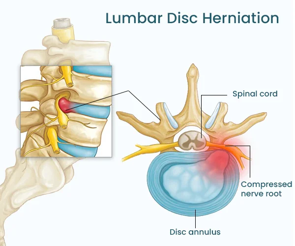 <p>ring tears and some of the nucleus pulposus protrudes onto the spinal cord</p>