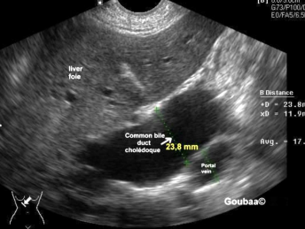 <p><span style="color: yellow;">Ill-defined/irregular borders, hypoechoic, solid lesion</span></p><p>Also shows dilated ducts and biliary obstruction, no vascularity</p><p>(ie. Abnormally dilated CBD due to mass in head of pancreas, jaundice, weight loss)</p>