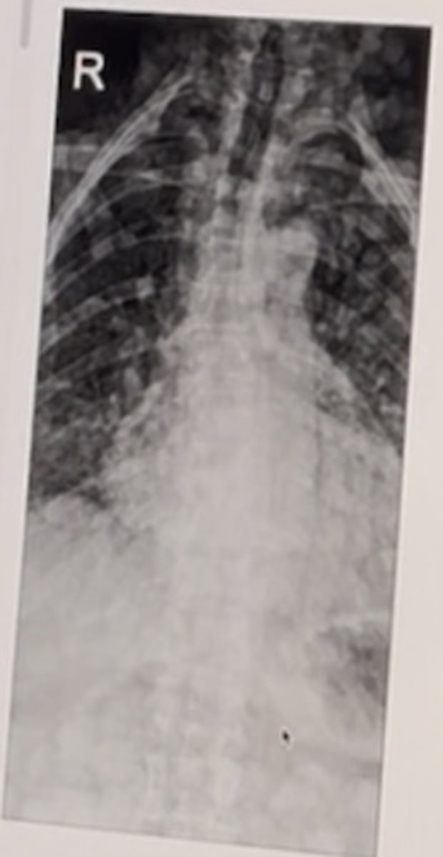 <p>neurofibromatosis</p><p>3 multiple choice options</p>