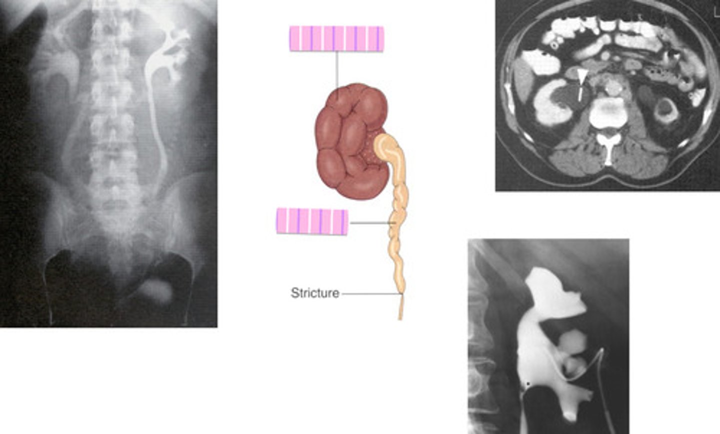 <p>What is the condition where one or both kidneys become stretched and swollen as the result of a build-up of urine inside them?</p>