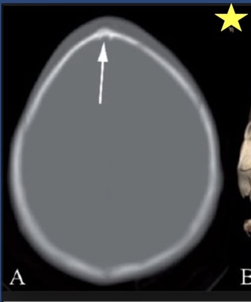 <p>Identify the radiographic abnormality, caused by metopic craniosynostosis.</p>
