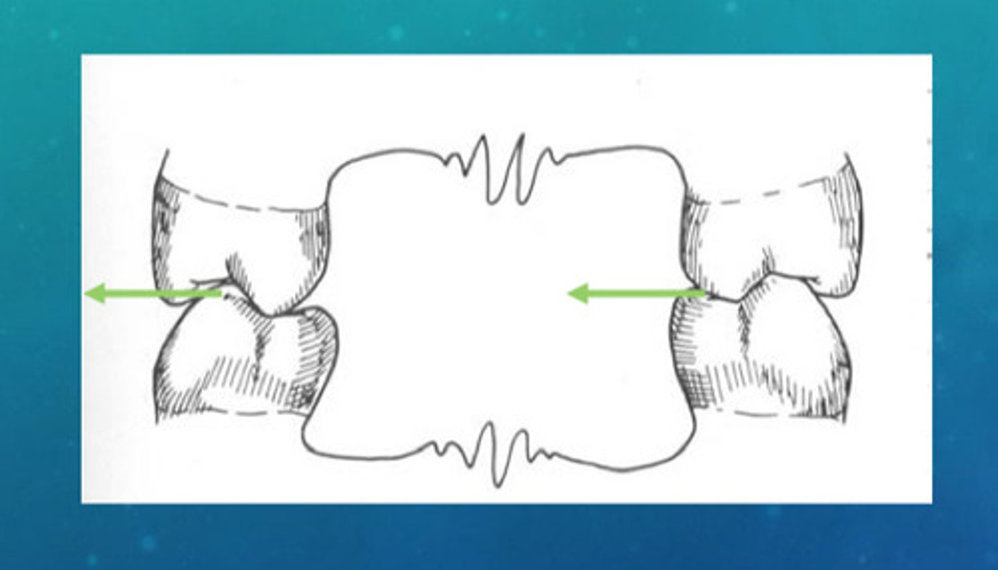 <p>immediate movement before translation; the mandible will not disclude in a vertical direction, therefore will result in occlusal interferences before the teeth separate</p>