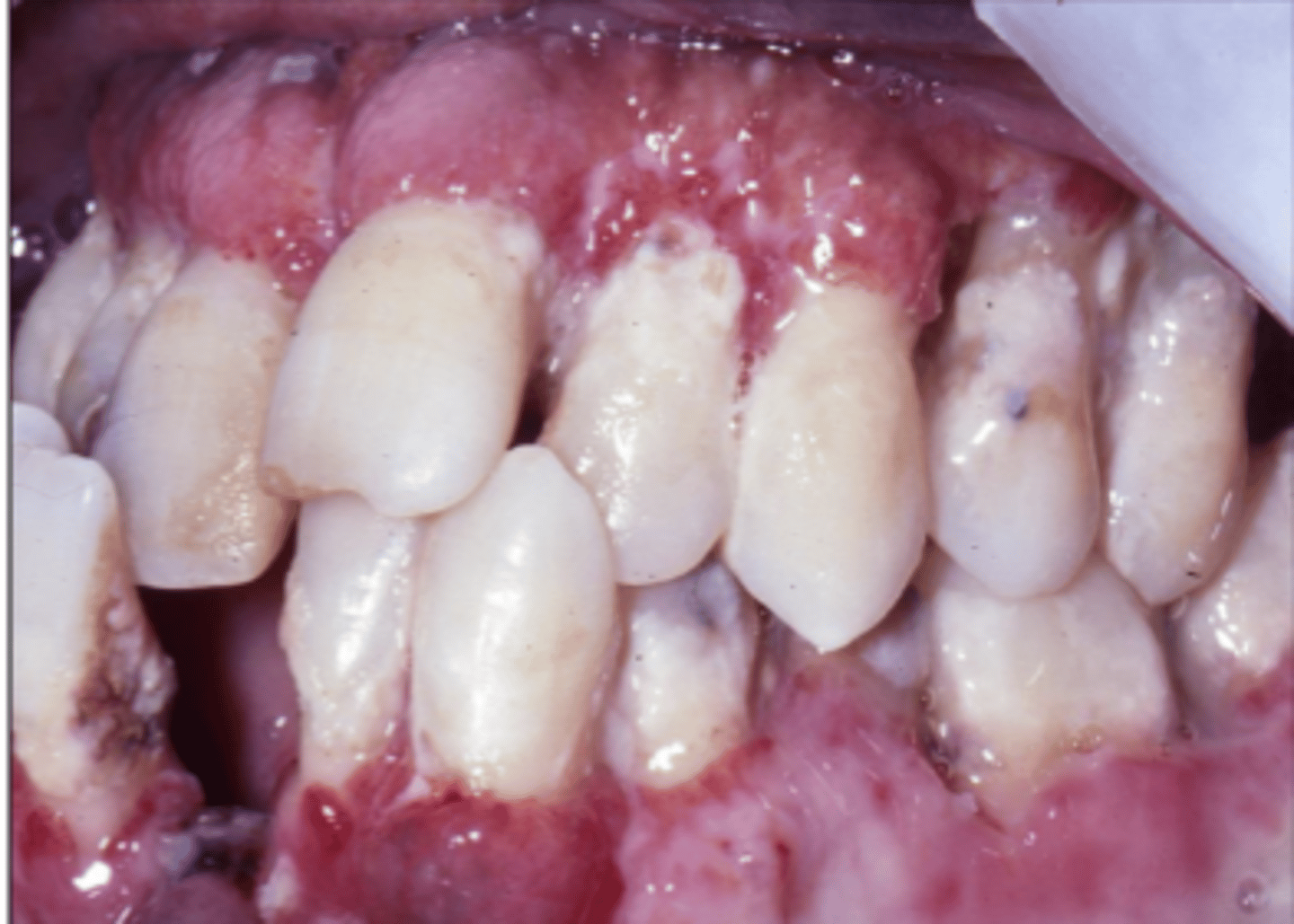 <p>histoplasmosis ; If a patient is diagnosed with HIV, presentation of this diseases is a sign of crossing over into AIDS</p>