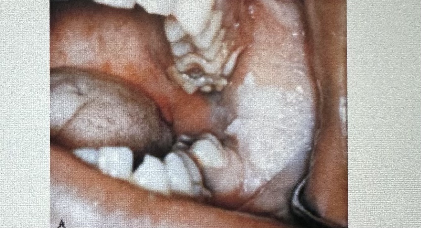 <p><span>A patient comes to the office for an emergency visit. The patient complains of a toothache in the left mandibular posterior area. On clinical examination you notice a gray-to-white patch on the left posterior buccal mucosa. On questioning, the patient tells you that this area is also painful. After reviewing the patients medical history, you question the patient regarding his recent use of:<br><br>A. hydrogen peroxide<br>B. aspirin<br>C. antibiotics<br>D. mouthwash</span></p>