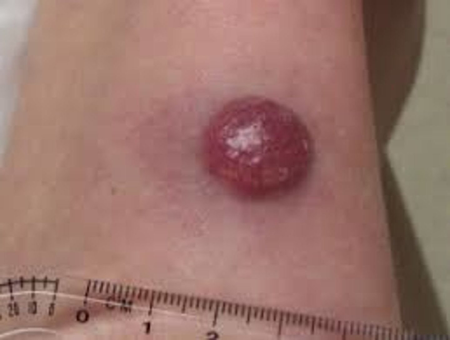<p>rare form of skin cancer, develops from neuroendocrine cells, which are hormone making cells, in the skin.</p>