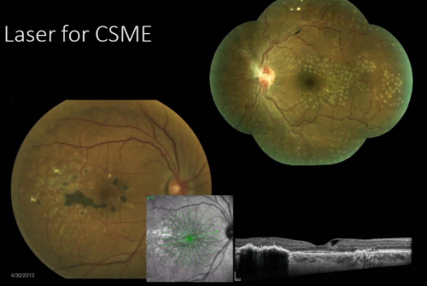 <p>What are some alternative tx for macular edema?</p>