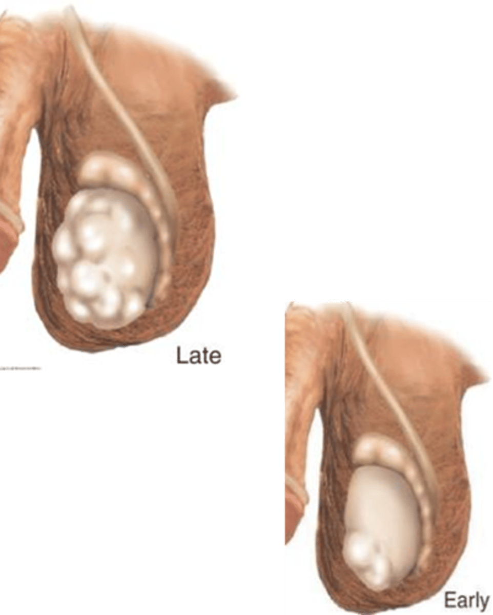 <p>Unilateral nodule, painless testicular enlargement (any firm large area is suspicious, CA is the diagnosis until proven otherwise), ache or heavy sensation, secondary hydrocele, +/- pain, possibly asymptomatic, gynecomastia</p>