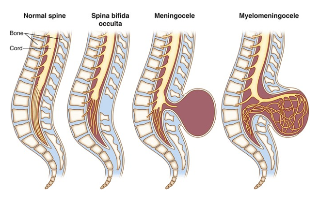 <p><span>•<strong><u>Spina Bifida</u>: </strong>Developmental anomaly, lamina of vertebral segment fails to close</span></p><p></p><p><span>3 Types:</span></p><p></p><p><span>•<strong><u>Spina Bifida Occulta</u></strong></span></p><p><span>•No herniation through defect</span></p><p><span>•Rare neurological deficits</span></p><p><span>•often only physical sign is coarse hair patch over the defect site.</span></p><p></p><p><span>•<strong><u>Spina Bifida Meningocele</u></strong></span></p><p><span>•Herniation of the meninges through defect.</span></p><p></p><p><span>•<strong><u>Spina Bifida Meningomyelocele</u></strong></span></p><p><span>•Herniation of meninges and nerve root through defect.</span></p><p><span>•Associated with neurological deficits.</span></p>