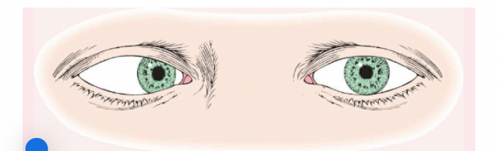 <p><span>(eye turns inward).</span></p>