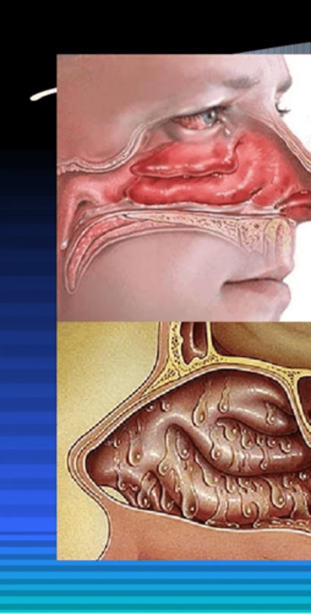 <p>Symptoms of allergic rhinitis</p>