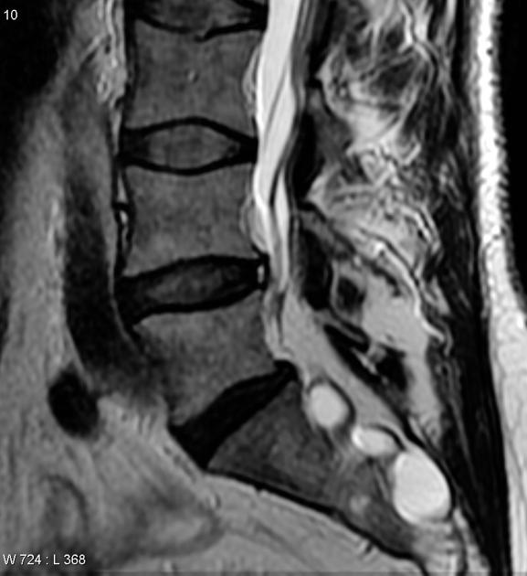 <p>What might the high signal at the posterior aspect of the disc be?</p>