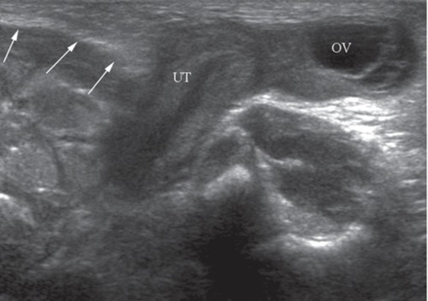 <p>Direct = contents do not pass through inguinal ring</p><p>Indirect = contents pass through inguinal ring</p>