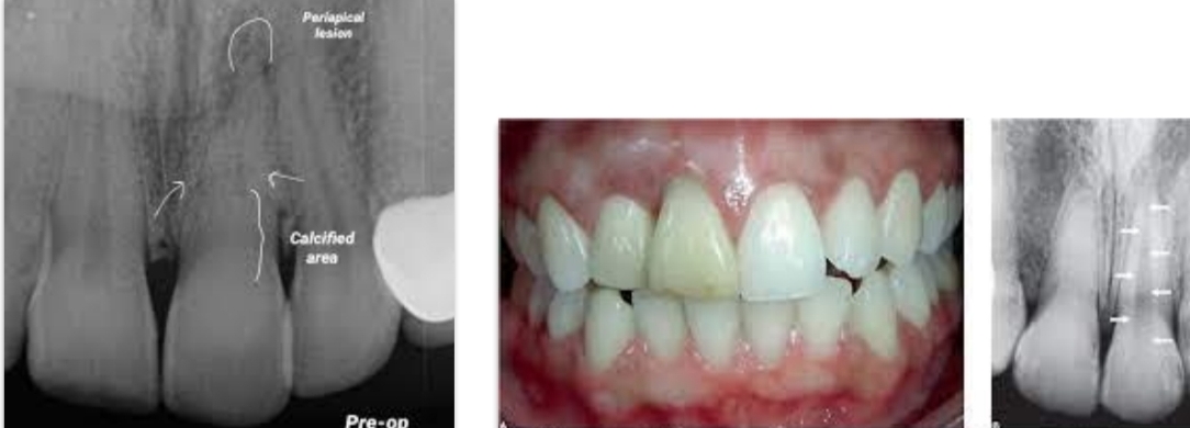 <p>Tooth’s trauma response - canal partially/completely filled with hard tissue</p><p class="has-focus">Yellow discoloration of crown</p>
